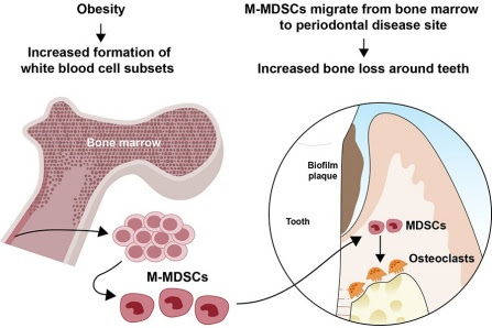 The graphic demonstrates how MDSC expansion during obesity to become bone destroying osteoclasts during gum disease is tied to increased bone loss around teeth. (Photo: Keith Kirkwood)