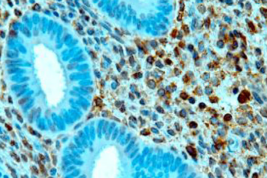 A microscopic photo of endometrium showing brown staining in many of the tissue's stromal cells, along with blue glands essentially devoid of brown staining. The brown pigment indicates the presence of BDNF (brain-derived neurotrophic factor), a potent growth factor protein that stimulates nerves to proliferate and migrate through the tissue, increasing the transmission of pain. (Photo courtesy of the University at Buffalo)